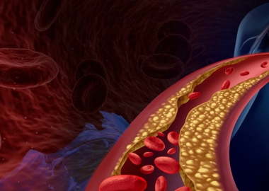 7 მარტივი გზა სისხლძარღვების ბუნებრივად გასაწმენდად